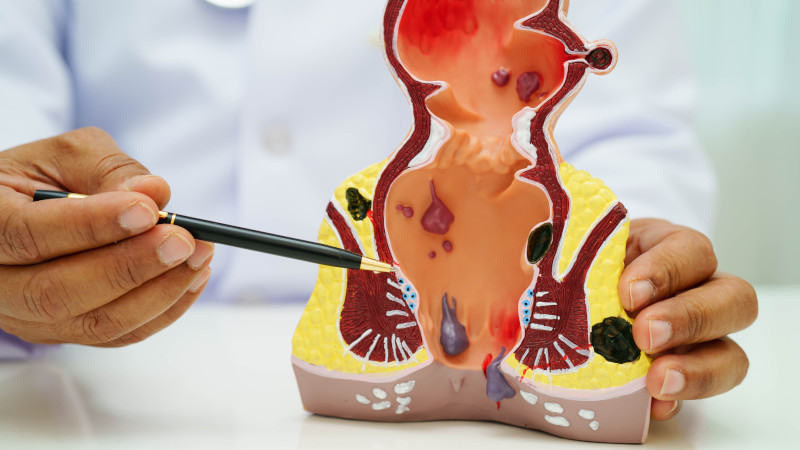 Visita proctologica e HPV rettale - Centro Medico Bologna e Verona Omniclinics
