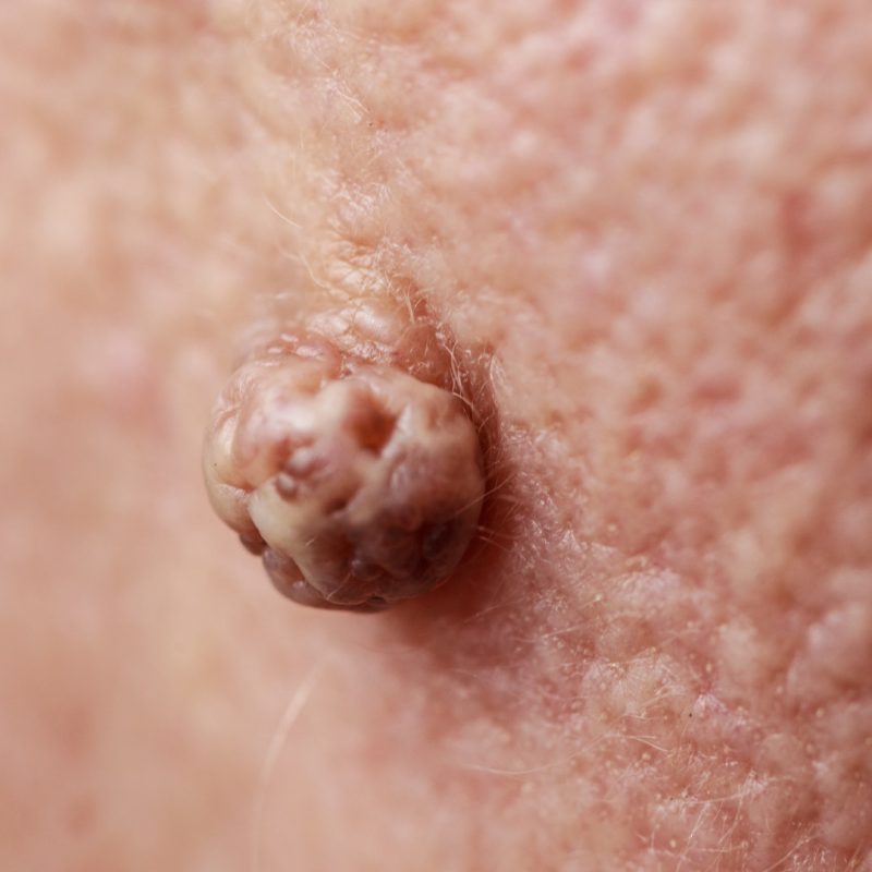 Centro HPV Bologna Omniclinics - Centro Multidisciplinare per diagnosi e trattamento del Papillomavirus